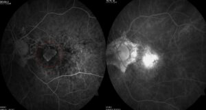Fluoreszenzangiographie bei feuchter AMD: Schon nach wenigen Sekunden zeigt sich die fächerförmige Gefäßneubildung (rot umrandet). Aus den krankhaften Gefäßen entweicht nach und nach Flüssigkeit, welche zu einem Makulaödem führt. Der austretende Farbstoff lässt die Konturen der Gefäße nicht mehr erkennen.(linke Bildseite) Fluoreszenzangiographie bei feuchter AMD: Schon nach wenigen Sekunden zeigt sich die fächerförmige Gefäßneubildung (rot umrandet). Aus den krankhaften Gefäßen entweicht nach und nach Flüssigkeit, welche zu einem Makulaödem führt. Der austretende Farbstoff lässt die Konturen der Gefäße nicht mehr erkennen.(linke Bildseite)