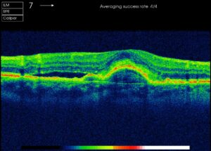 Feuchte AMD: Direkt unter der Fovea ist das Pigmentepithel aufgeworfen, links davon ist Flüssigkeit unter der Netzhaut ausgetreten. Feuchte AMD: Direkt unter der Fovea ist das Pigmentepithel aufgeworfen, links davon ist Flüssigkeit unter der Netzhaut ausgetreten.