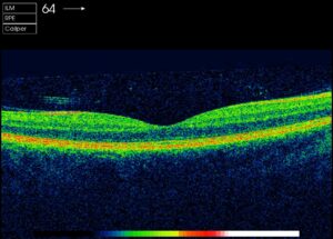 Die Netzhautschichten sind regelmäßig dargestellt. Zentral zeigt die Einsenkung die Stelle des schärfsten Sehens (Fovea) an. Die Netzhautschichten sind regelmäßig dargestellt. Zentral zeigt die Einsenkung die Stelle des schärfsten Sehens (Fovea) an.