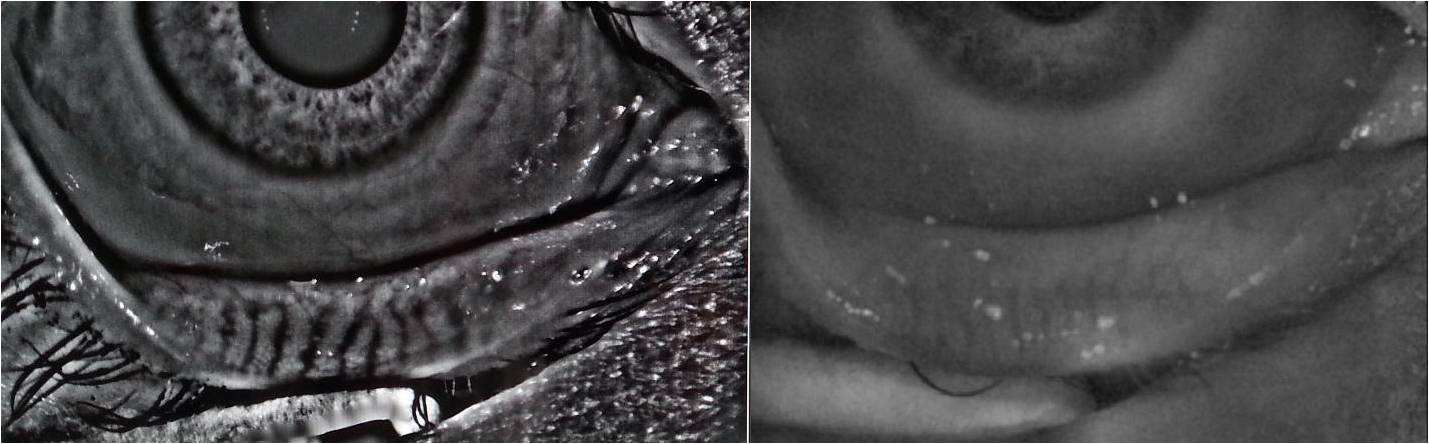 meibographie-handzel-1