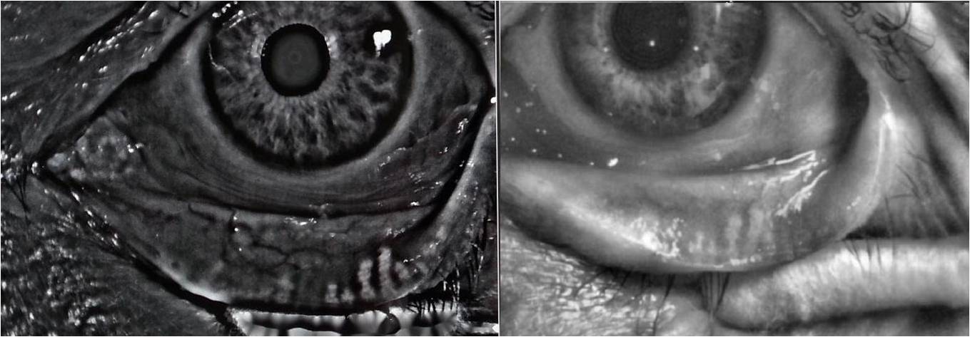 meibographie-handzel-2