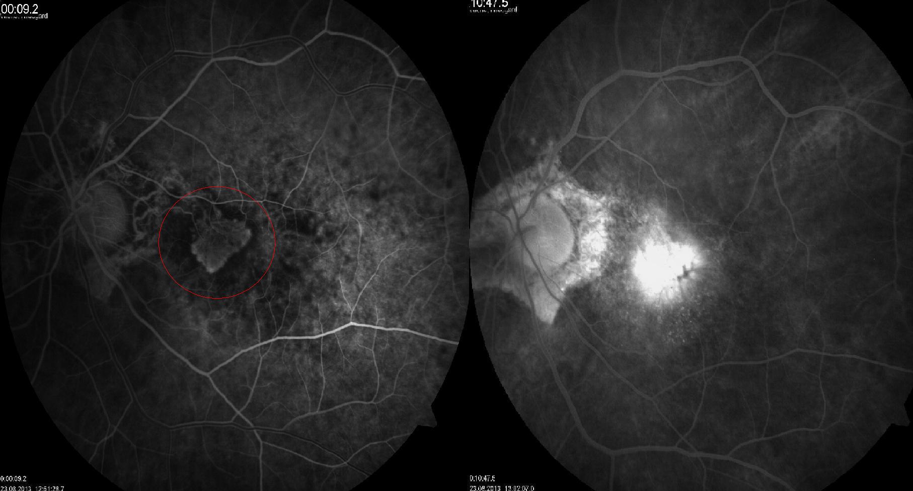 Angiographie-AMD-Handzel