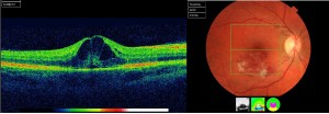 Retinaler Venenverschluss der Makula: es bestehen viele Netzhautblutungen (rechtes Bild). Die Optische Cohärenztomographie zeigt das Ausmaß der Schwellung (linkes Bild).